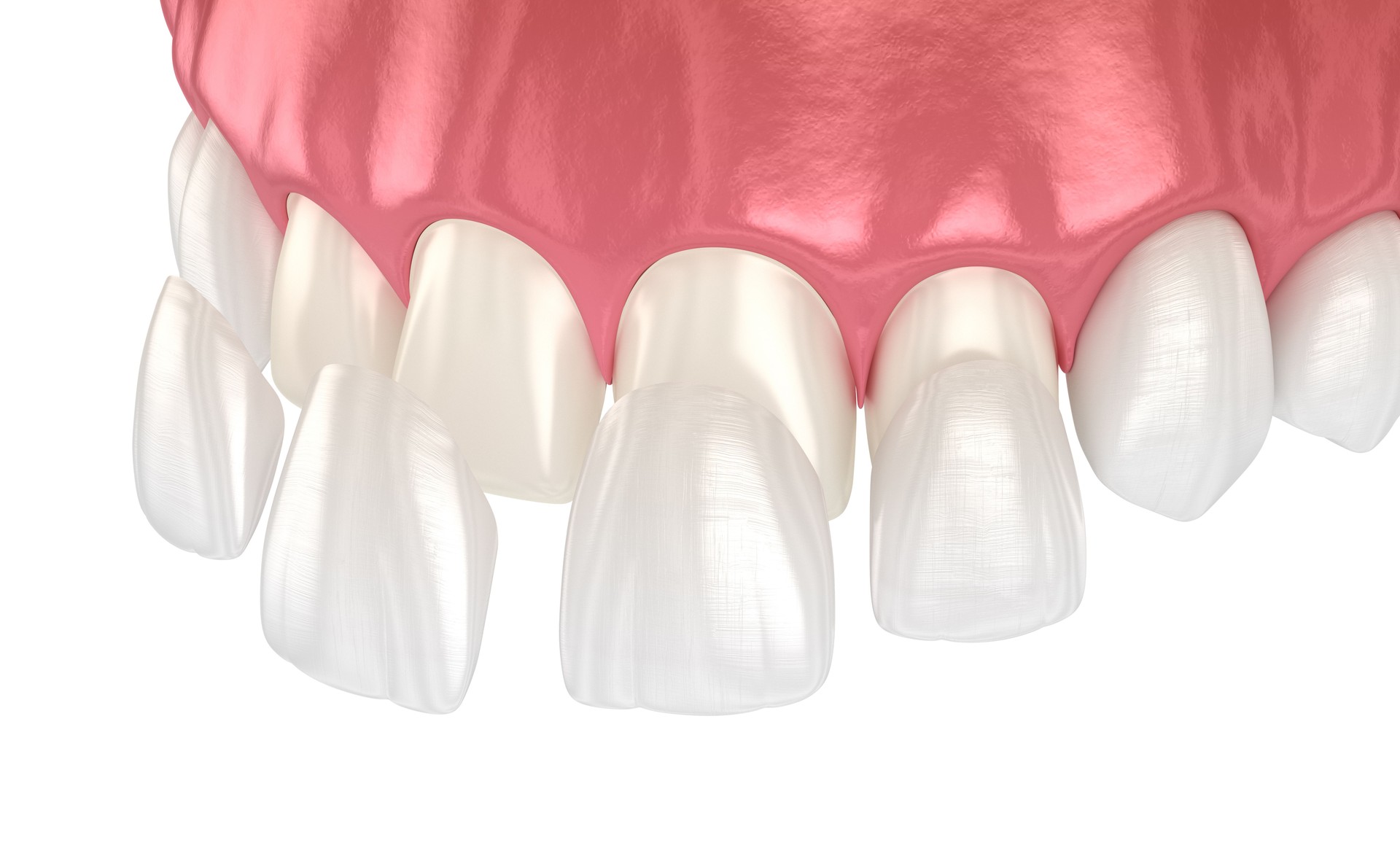 Dental veneer