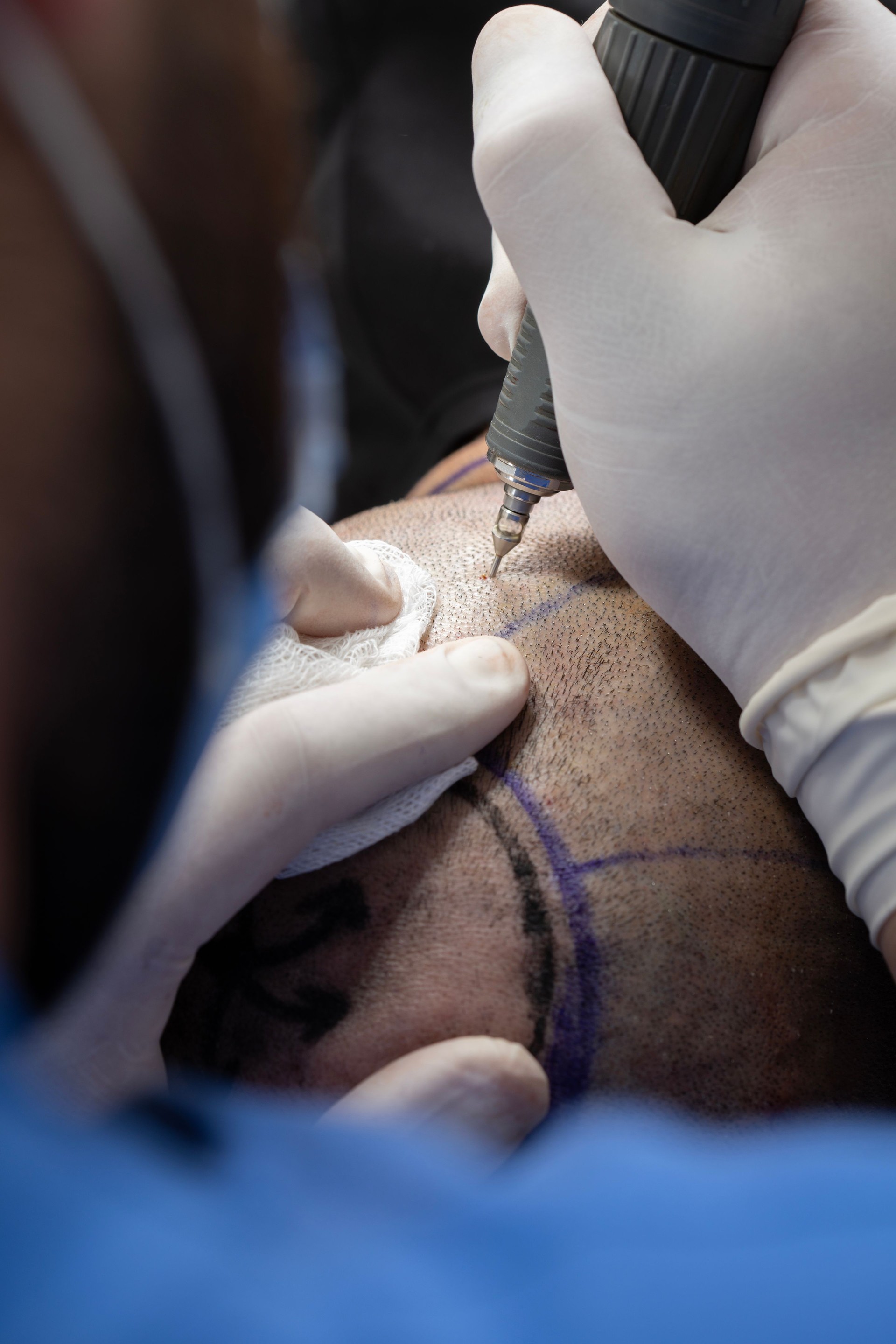 Haartransplantation