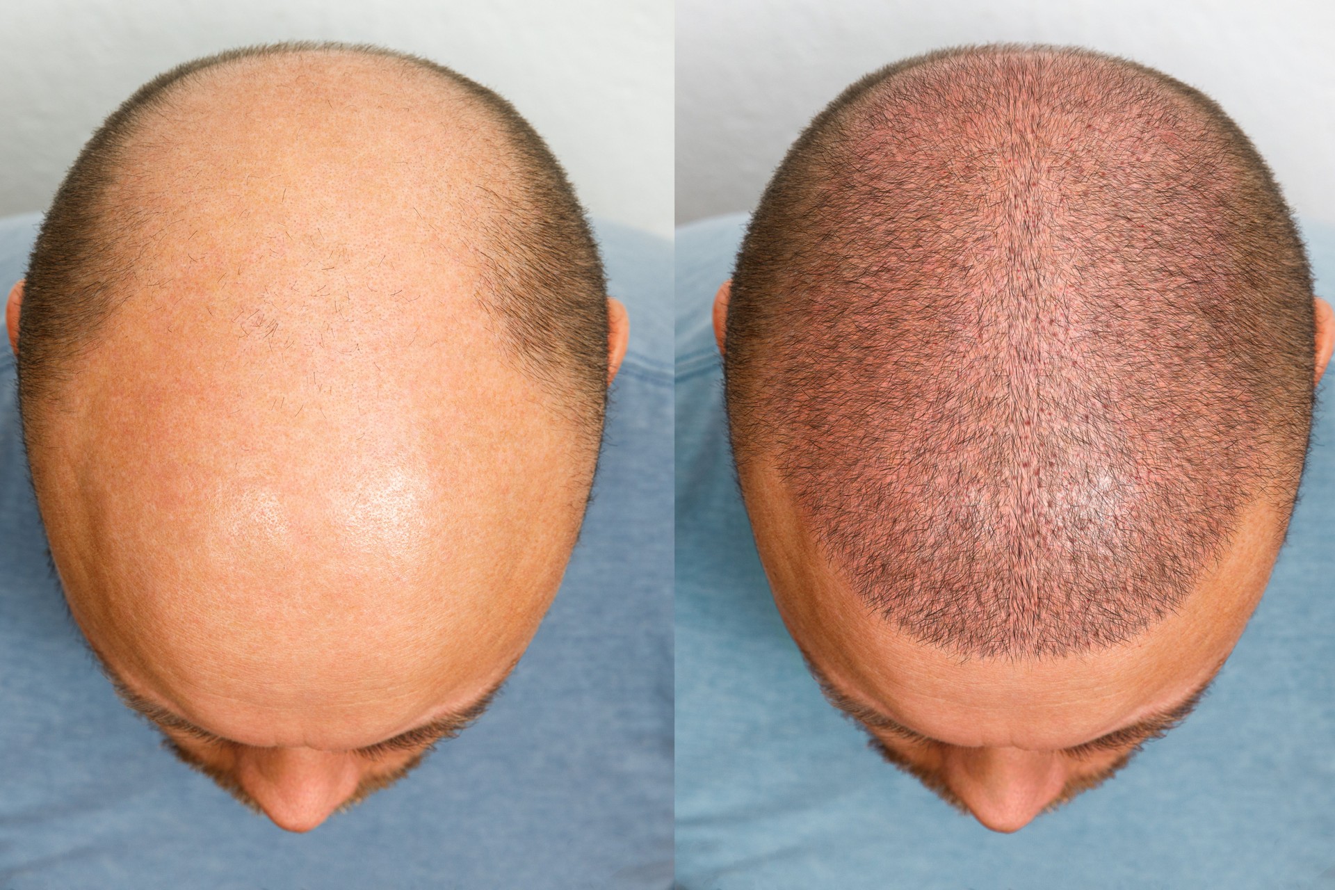 Vor und nach einer Haartransplantation