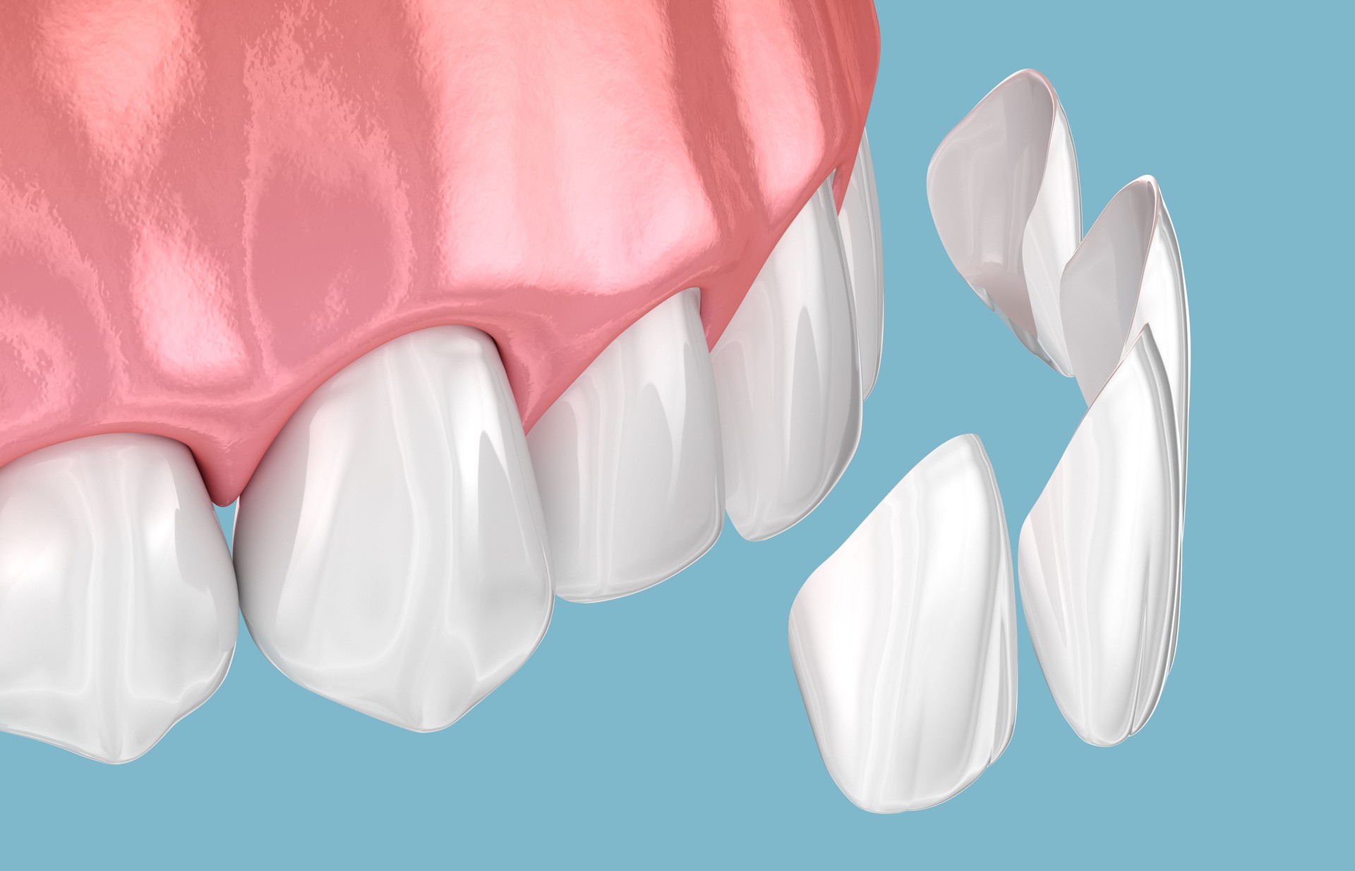 Dentalveneers