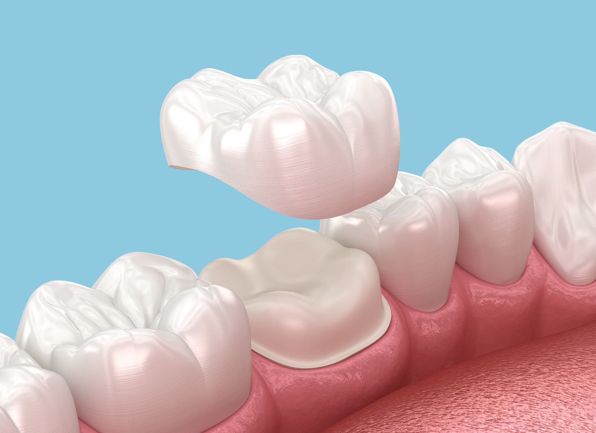 E-max Dental veneer