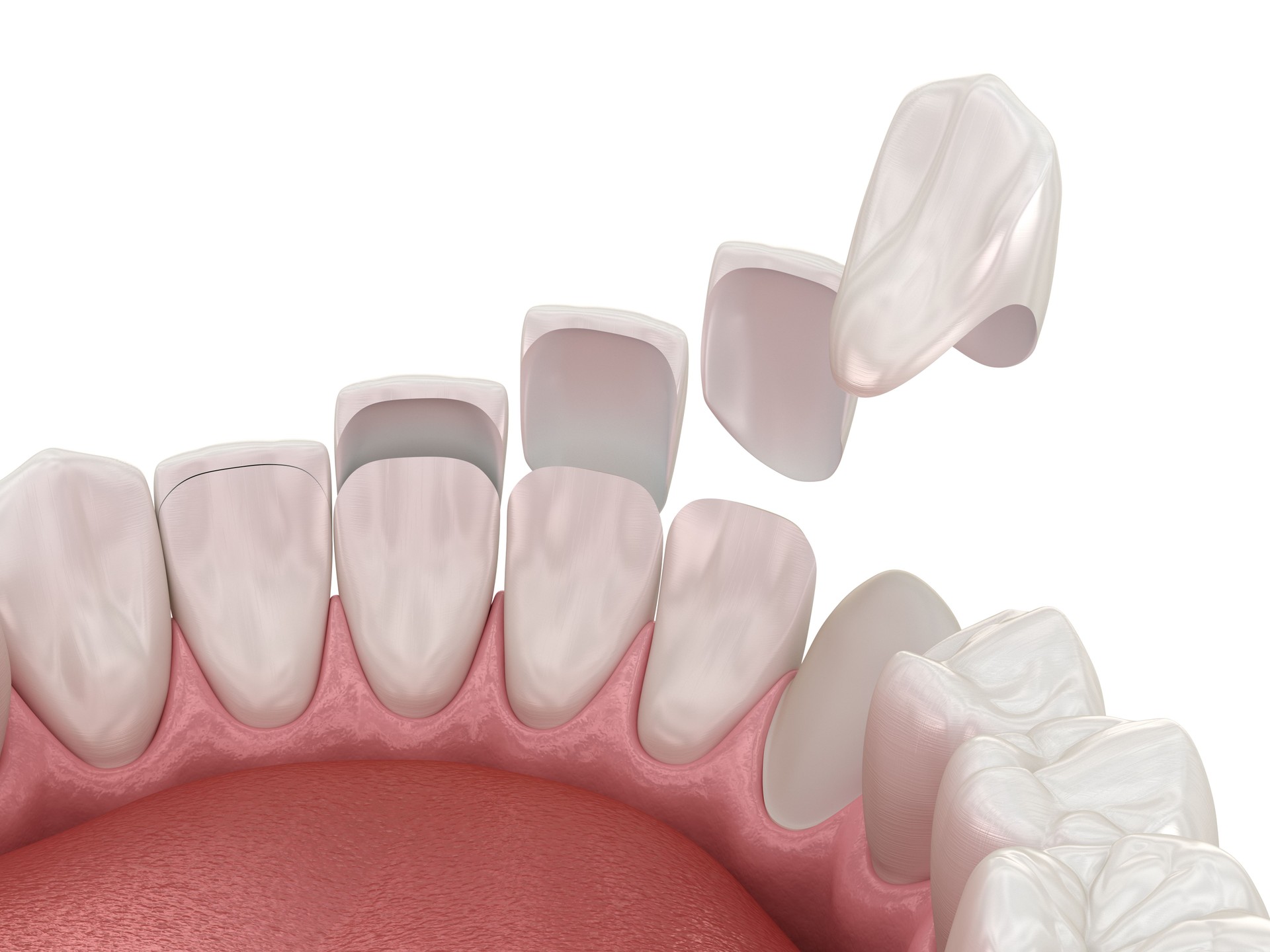 Dentalveneers