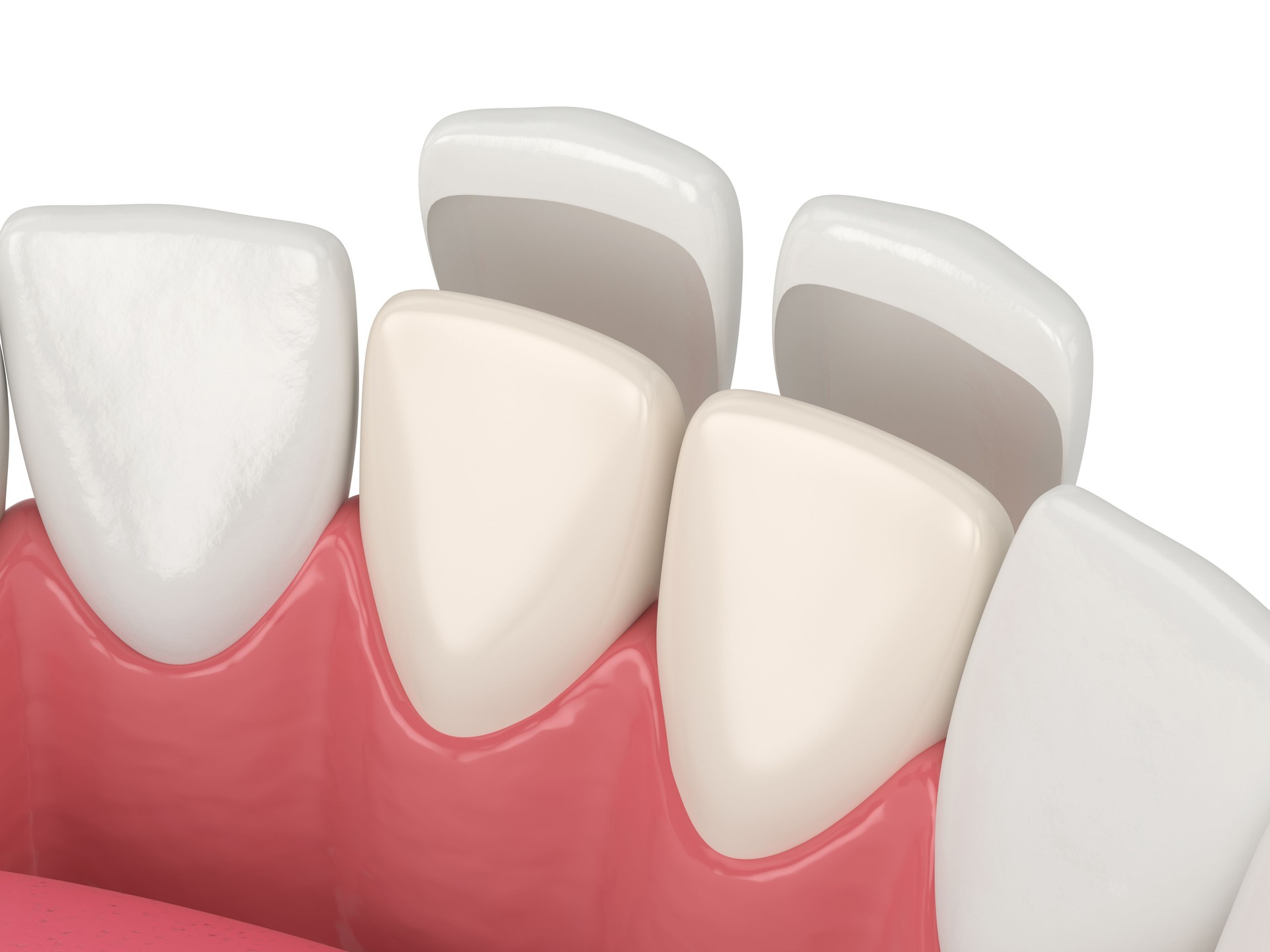 Lamina Dental veneer